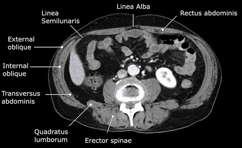 Very large incisional hernia. Red arrows - Separated abdominal walls - atrophic rectus abdominis muscle (Courtesy Dr. V. Penopoulos)