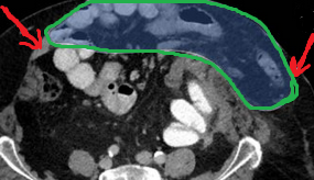Very large incisional hernia. Red arrows - Separated abdominal walls - atrophic rectus abdominis muscle (Courtesy Dr. V. Penopoulos)
