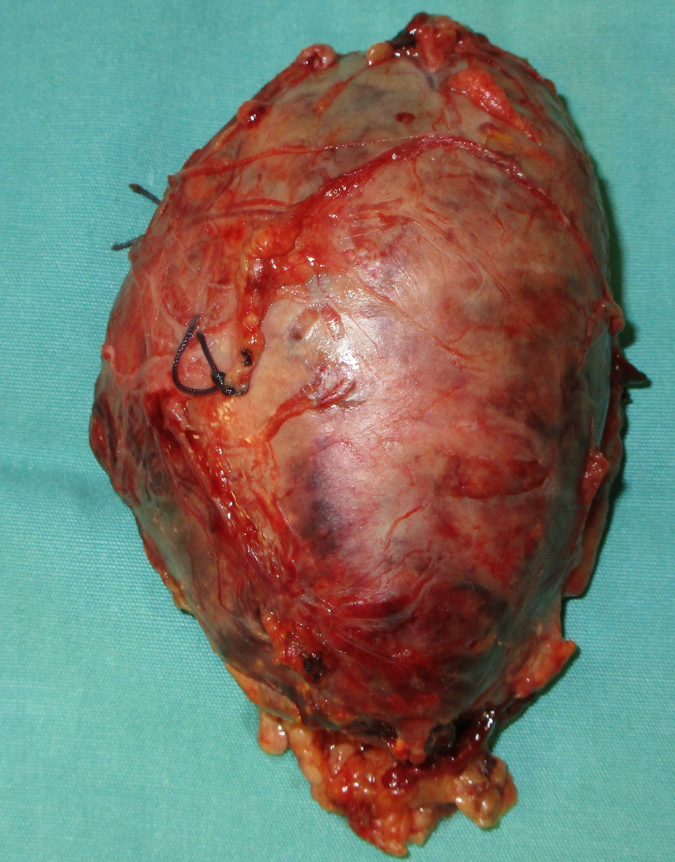 Right adrenalectomy specimen for pheochromocytoma (Courtesy Dr. V. Penopoulos)