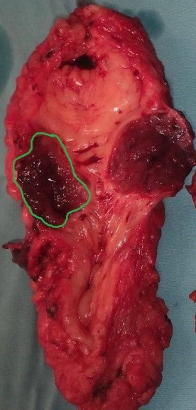 Βιοψία μασχαλιαίου λεμφαδένα (Ευγενική παραχώρηση Dr. V. Penopoulos)