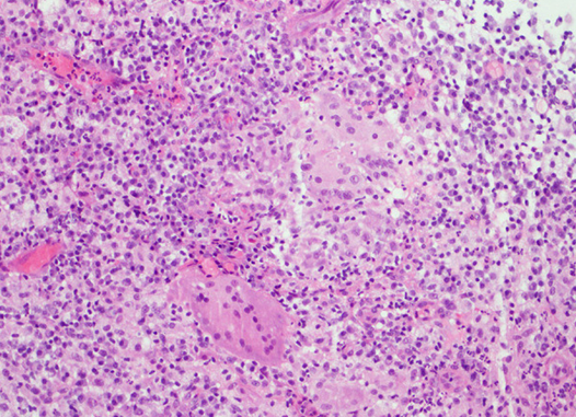 Ιστολογική εικόνα μη τυροποιητικών κοκκιωμάτων (Ευγενική παραχώρηση Dr. V. Penopoulos)