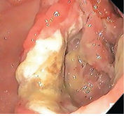 Παρασκεύασμα ολικής γαστρεκτομής (Ευγενική παραχώρηση Dr. V. Penopoulos)