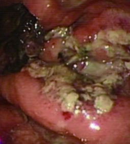 Παρουσία ποικιλομεγέθων στοιβαγμένων θυλακίων αποτελούμενων από κεντροκύτταρα, κεντροβλάστες και λεμφοκυτταρικά διηθήματα με λεμφοεπιθηλιακές βλάβες (Ευγενική παραχώρηση Dr. V. Penopoulos)