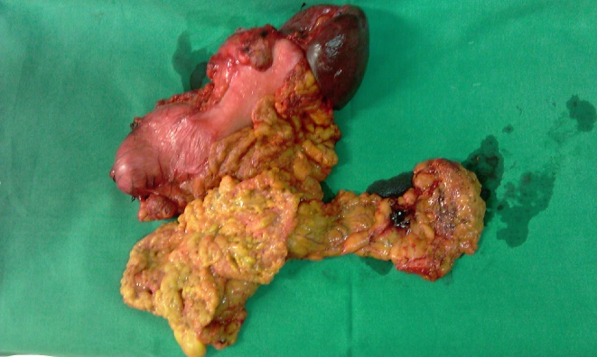 Παρουσία ποικιλομεγέθων στοιβαγμένων θυλακίων αποτελούμενων από κεντροκύτταρα, κεντροβλάστες και λεμφοκυτταρικά διηθήματα με λεμφοεπιθηλιακές βλάβες (Ευγενική παραχώρηση Dr. V. Penopoulos)