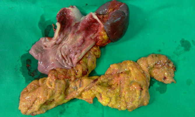 Έλεγχος στεγανότητας και βατότητας της οισοφαγονηστιδικής αναστόμωσης (Ευγενική παραχώρηση Dr. V. Penopoulos)