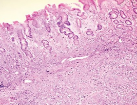 Ψηφιακή μαστογραφία. Παρουσία μάζας υψηλής πυκνότητας, ακανόνιστου σχήματος (Ευγενική παραχώρηση Dr. V. Penopoulos)