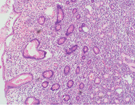 CT θώρακα. Παρουσία μεγάλης, ακανόνιστης μάζας στο δεξιό μαστό (Ευγενική παραχώρηση Dr. V. Penopoulos)