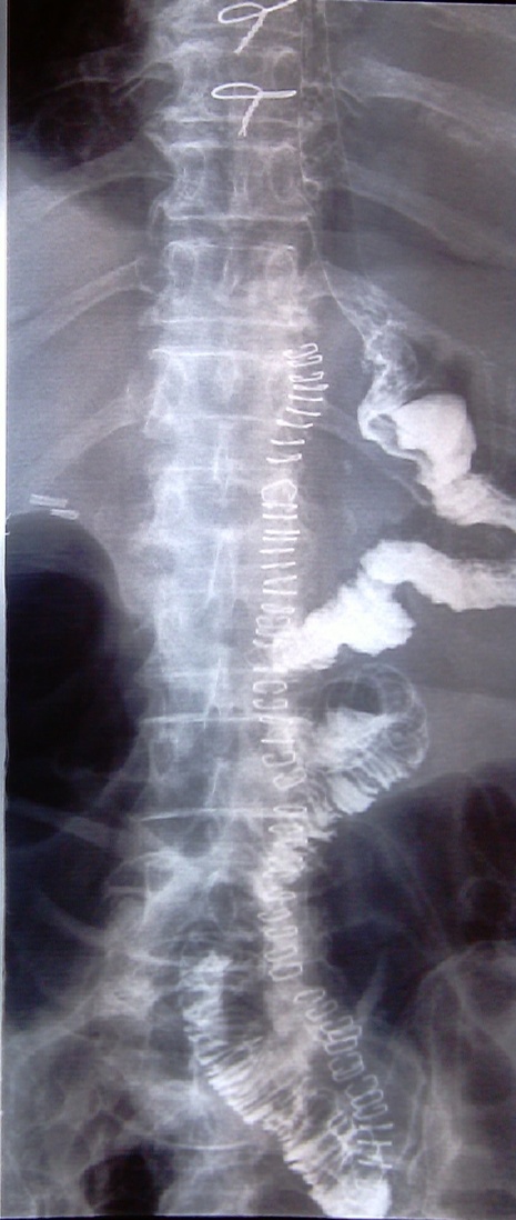 MRI μαστογραφία. Ετερογενής ενισχυμένη πρόσληψη γαδολινίου στον δεξιό μαστό (Ευγενική παραχώρηση Dr. V. Penopoulos)
