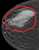 PET scan. Εμφανής η υπερμεταβολική εστία στον δεξιό μαστό (Ευγενική παραχώρηση Dr. V. Penopoulos)