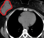 PET scan. Εμφανής η υπερμεταβολική εστία στον δεξιό μαστό (Ευγενική παραχώρηση Dr. V. Penopoulos)
