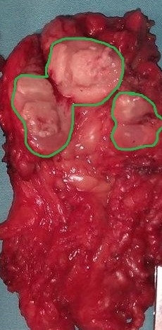 Ανοικτή βιοψία μαστού (Ευγενική παραχώρηση Dr. V. Penopoulos)