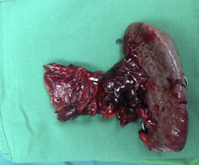 Distal pancreatectomy-splenectomy specimen, with the ruptured splenic artery aneurysm visible (Courtesy Dr. V. Penopoulos)