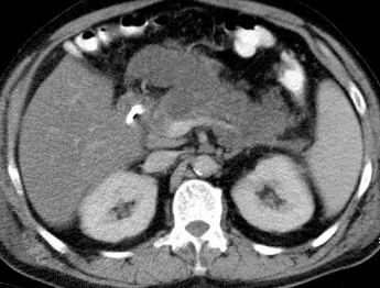 CT Scan. Acute idiopathic pancreatitis (Courtesy Dr. V. Penopoulos)