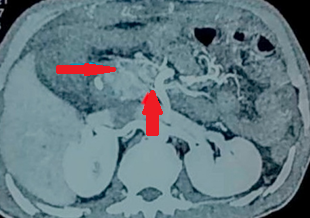 CT Angiography. Presence of a ruptured pseudoaneurysm of the common hepatic artery (Courtesy Dr. V. Penopoulos)