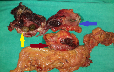 Abdominal CT. Acute exudative pancreatitis (Courtesy Dr. V. Penopoulos)