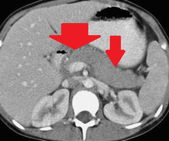 Abdominal CT. Acute exudative pancreatitis (Courtesy Dr. V. Penopoulos)