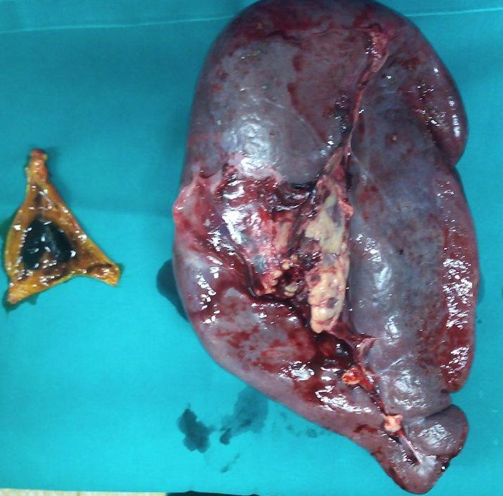 Spleen and gallbladder specimen (Courtesy Dr. V. Penopoulos)