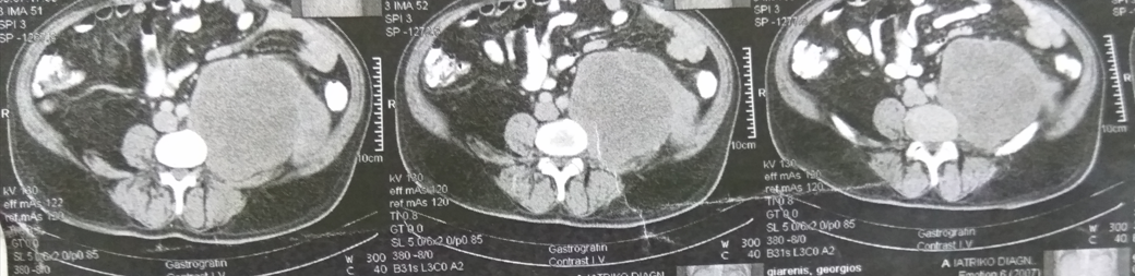 Ανοσοϊστοχημική εξέταση - CD31 (+) (Ευγενική παραχώρηση Dr. V. Penopoulos)