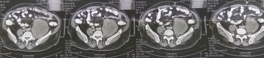 Ανοσοϊστοχημική εξέταση - CD31 (+) (Ευγενική παραχώρηση Dr. V. Penopoulos)