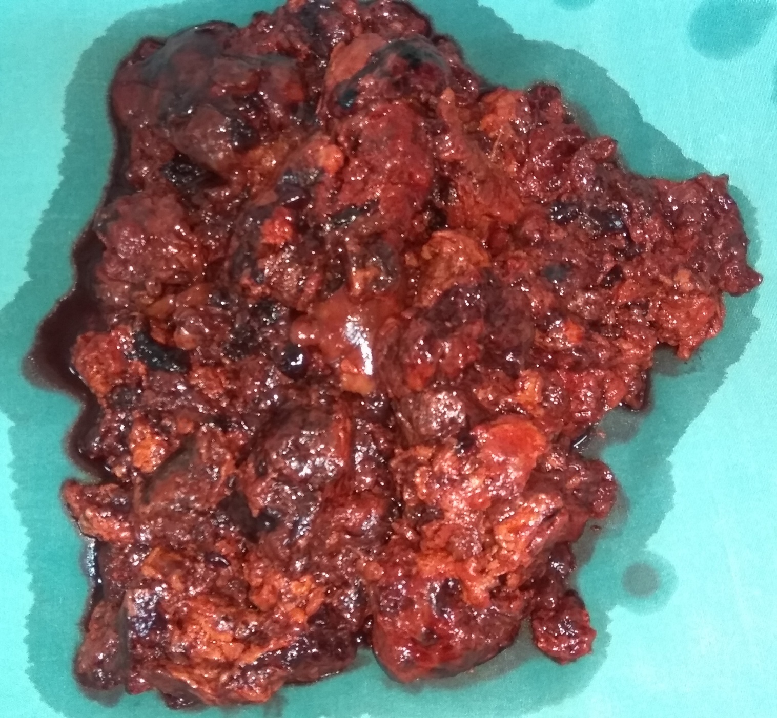 Ανοσοϊστοχημική εξέταση - CD31 (+) (Ευγενική παραχώρηση Dr. V. Penopoulos)