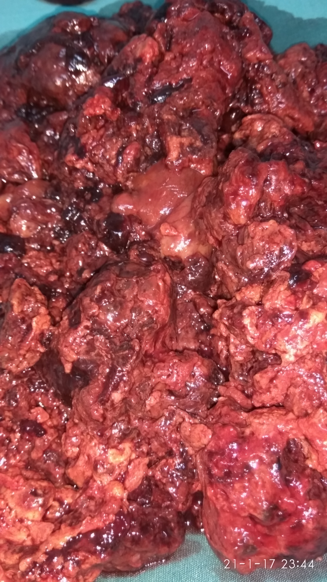 Ανοσοϊστοχημική εξέταση - CD31 (+) (Ευγενική παραχώρηση Dr. V. Penopoulos)