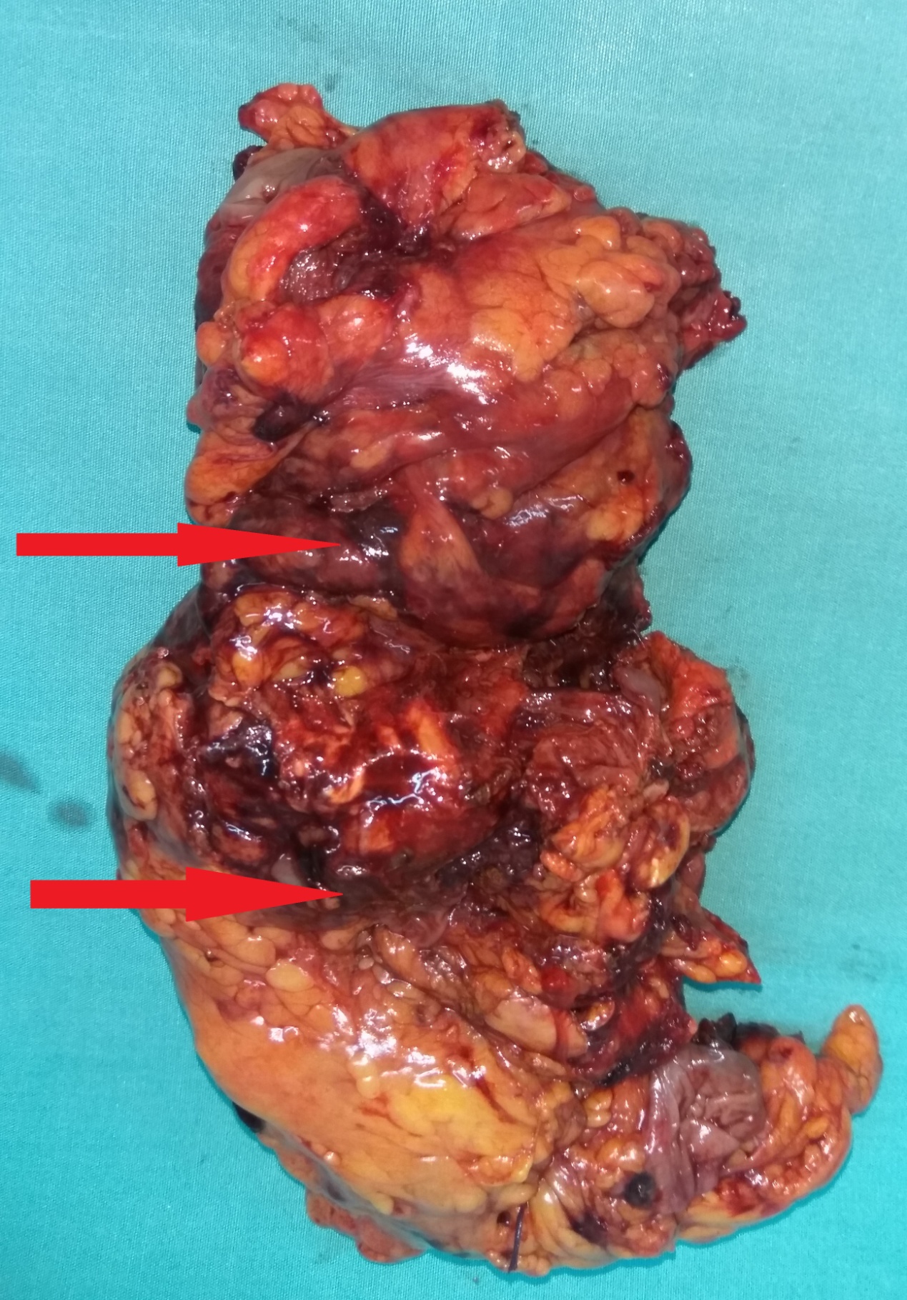 Ανοσοϊστοχημική εξέταση - CD31 (+) (Ευγενική παραχώρηση Dr. V. Penopoulos)