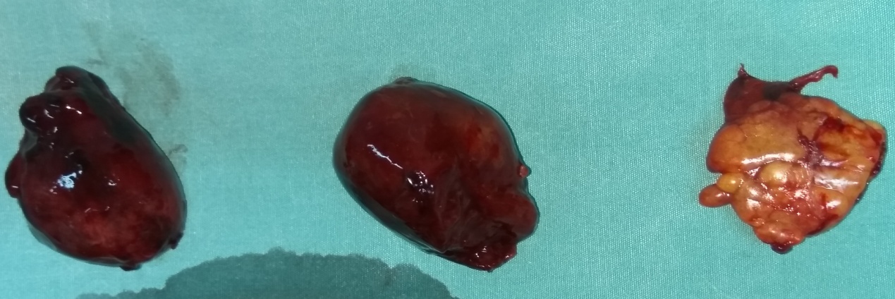 Ανοσοϊστοχημική εξέταση - CD31 (+) (Ευγενική παραχώρηση Dr. V. Penopoulos)