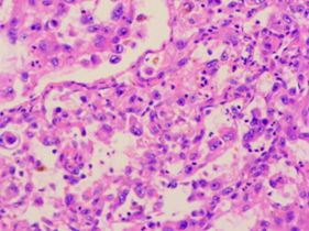 Επιθηλιοειδή κακοήθη κύτταρα, με εμφανή κυτταρική ατυπία και μιτωτικές φιγούρες (Ευγενική παραχώρηση Dr. V. Penopoulos)