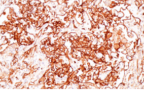 Ανοσοϊστοχημική εξέταση - CD31 (+) (Ευγενική παραχώρηση Dr. V. Penopoulos)