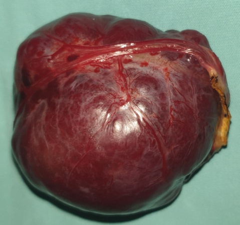 Specimen of liver stromal tumor, 12.4 x 17 x 8.5 cm (Courtesy Dr. V. Penopoulos)
