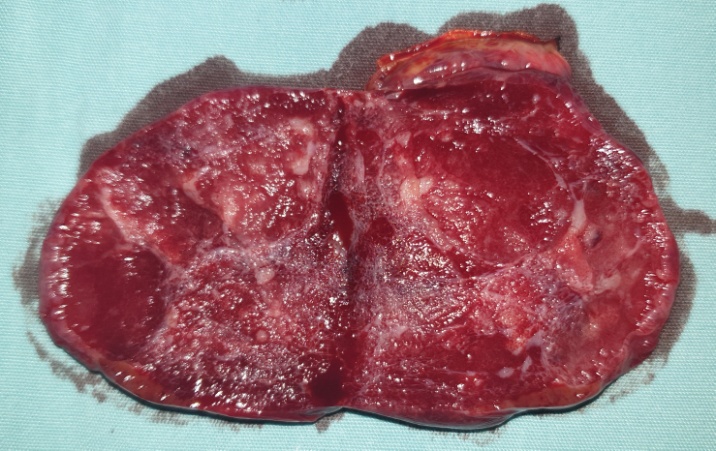 Spindle-shaped cells organized in fascicles, with hyperchromatic nuclei (Courtesy Dr. V. Penopoulos)