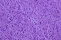 Spindle-shaped cells organized in fascicles, with hyperchromatic nuclei (Courtesy Dr. V. Penopoulos)