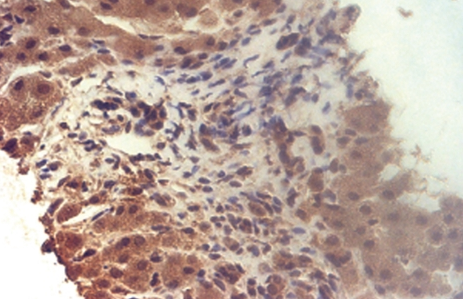 Diffuse and strongly positive expression for CD117 (Courtesy Dr. V. Penopoulos)