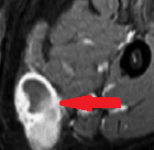 MRI μηροβουβωνικής πτυχής με σκιαγραφικό, που αναδεικνύει μαλακοτισθενή μάζα εκφυόμενη από τη μεγάλη σαφηνή φλέβα (Ευγενική παραχώρηση Dr. V. Penopoulos)