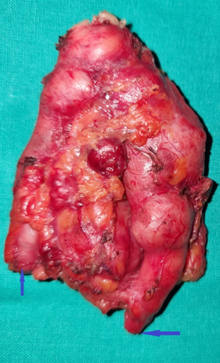 Πολλαπλές πνευμονικές μεταστάσεις (Ευγενική παραχώρηση Dr. V. Penopoulos)