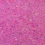 Πολλαπλές πνευμονικές μεταστάσεις (Ευγενική παραχώρηση Dr. V. Penopoulos)