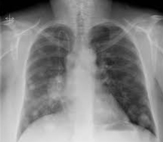 Πολλαπλές πνευμονικές μεταστάσεις (Ευγενική παραχώρηση Dr. V. Penopoulos)