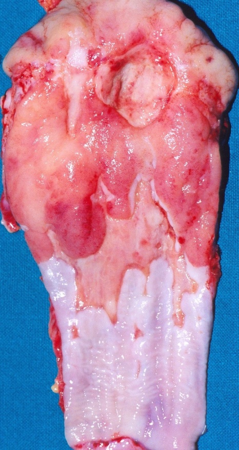 Intrathoracic esophagojejunal anastomosis (Courtesy Dr. V. Penopoulos)