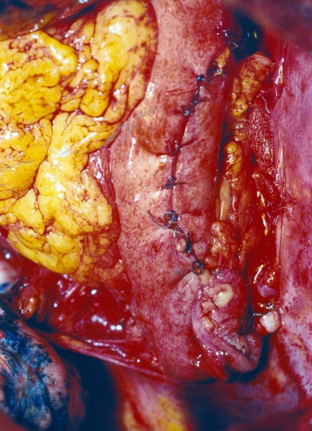 Intrathoracic esophagojejunal anastomosis (Courtesy Dr. V. Penopoulos)