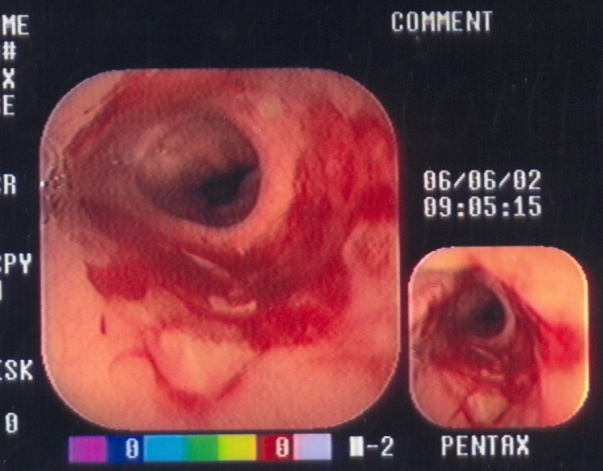 Intrathoracic esophagojejunal anastomosis (Courtesy Dr. V. Penopoulos)