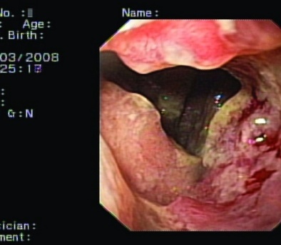 Intrathoracic esophagojejunal anastomosis (Courtesy Dr. V. Penopoulos)