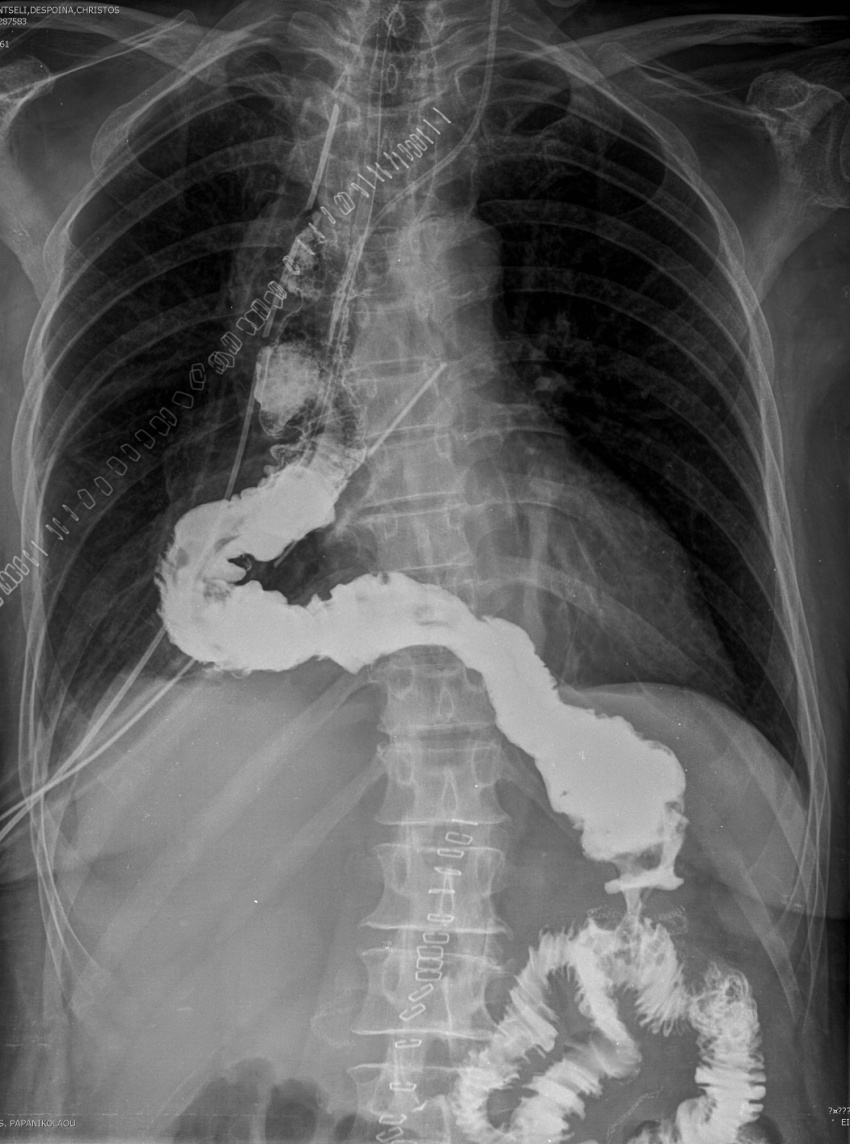 Intrathoracic esophagojejunal anastomosis (Courtesy Dr. V. Penopoulos)