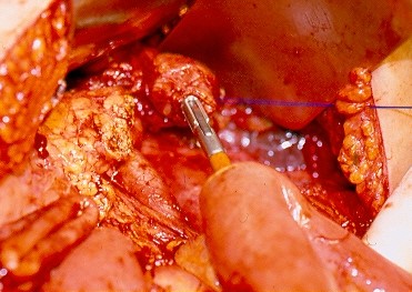Intrathoracic esophagojejunal anastomosis (Courtesy Dr. V. Penopoulos)
