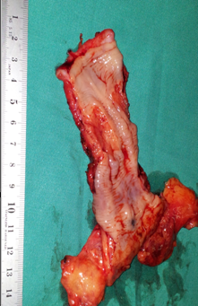 Adenosquamous carcinoma of the upper third of the esophagus (Courtesy Dr. V. Penopoulos)