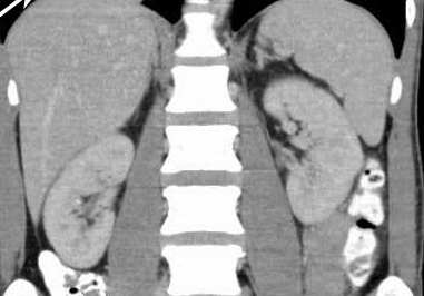 Right nephrectomy specimen (Courtesy Dr. V. Penopoulos)