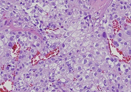 Right nephrectomy specimen (Courtesy Dr. V. Penopoulos)