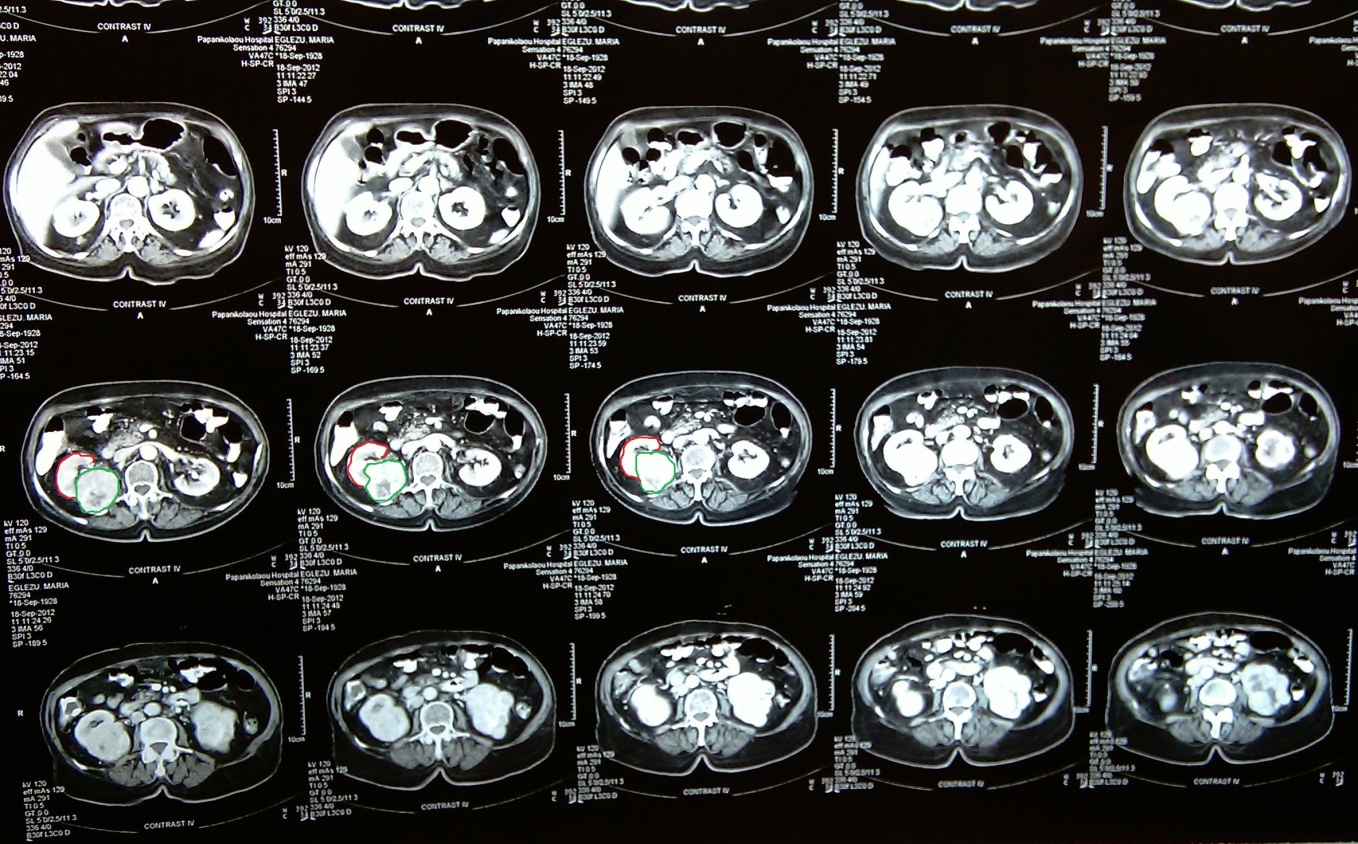 Right nephrectomy specimen (Courtesy Dr. V. Penopoulos)