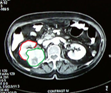 Right nephrectomy specimen (Courtesy Dr. V. Penopoulos)