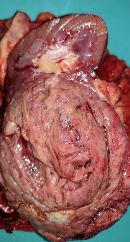 Right nephrectomy specimen (Courtesy Dr. V. Penopoulos)