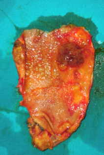 Χειρουργικά παρασκευάσματα. Πολύποδες χοληδόχου κύστης (Ευγενική παραχώρηση Dr. V. Penopoulos)